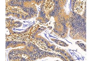 ABIN7093127 and ABIN7098695 at 1/100 staining Human colorectal cancer by IHC-P. (Clca3 抗体)