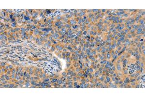 Immunohistochemistry of paraffin-embedded Human cervical cancer tissue using ADAMTS18 Polyclonal Antibody at dilution 1:30 (ADAMTS18 抗体)