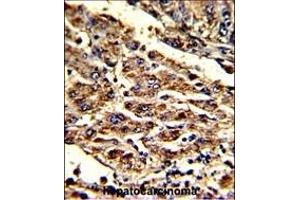 Formalin-fixed and paraffin-embedded human hepatocarcinoma with HOMER1 Antibody (N-term), which was peroxidase-conjugated to the secondary antibody, followed by DAB staining.
