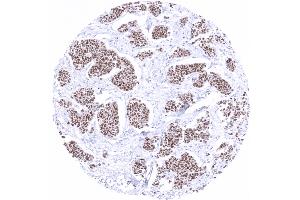 Breast Breast cancer of no special type NST showing moderate to strong GATA3 immunostaining (GATA3 抗体)