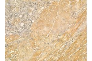ABIN6260540 and ABIN6276944 at 1/100 staining human tongue carcinoma by IHC-P. (CCL21 抗体  (C-Term))