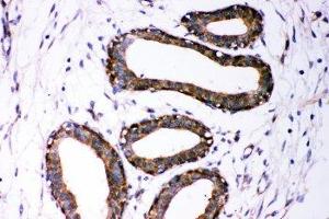 IHC-P: Dicer antibody testing of human breast cancer tissue (DICER1 抗体  (AA 1-195))