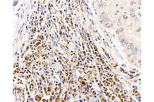 Immunohistochemistry analysis of paraffin-embedded human lung cancer using CASP1 Polyclonal Antibody at dilution of 1:300. (Caspase 1 抗体)