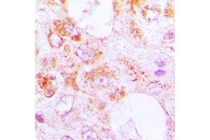 Immunohistochemical analysis of Centrin-3 staining in human lung cancer formalin fixed paraffin embedded tissue section.