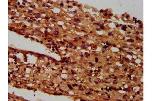 IHC image of ABIN7145527 diluted at 1:600 and staining in paraffin-embedded human melanoma performed on a Leica BondTM system. (SGCB 抗体  (AA 124-219))