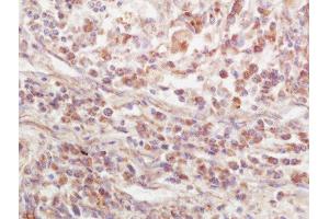 Formalin-fixed and paraffin embedded human lung carcinoma labeled with Rabbit Anti-EPS15R Polyclonal Antibody, Unconjugated  at 1:200 followed by conjugation to the secondary antibody and DAB staining (EPS15L1 抗体  (AA 275-380))