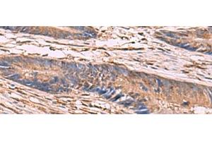 Immunohistochemistry of paraffin-embedded Human colorectal cancer tissue using KCNN2 Polyclonal Antibody at dilution of 1:65(x200) (KCNN2 抗体)