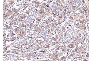 ABIN6275240 at 1/100 staining Human breast cancer tissue by IHC-P. (SLC25A21 抗体  (Internal Region))
