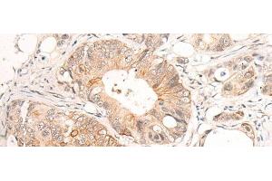 Immunohistochemistry of paraffin-embedded Human colorectal cancer tissue using HTRA1 Polyclonal Antibody at dilution of 1:55(x200) (HTRA1 抗体)