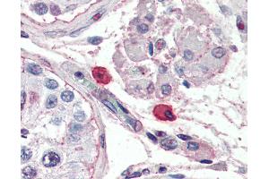Anti-FceR1 / Fc Epsilon Receptor 1 antibody IHC of human mast cells. (Fc epsilon Receptor 1 抗体)