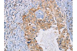 The image on the left is immunohistochemistry of paraffin-embedded Human cervical cancer tissue using ABIN7192619(SPAG6 Antibody) at dilution 1/30, on the right is treated with synthetic peptide. (SPAG6 抗体)