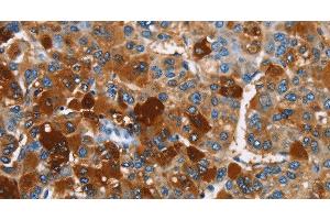 Immunohistochemistry of paraffin-embedded Human liver cancer using ARMCX2 Polyclonal Antibody at dilution of 1:40 (ARMCX2 抗体)