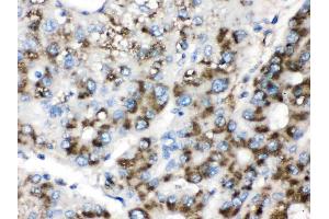 Catalase was detected in paraffin-embedded sections of human liver cancer tissues using rabbit anti- Catalase Antigen Affinity purified polyclonal antibody (Catalog # ) at 1 µg/mL. (Catalase 抗体  (AA 344-527))