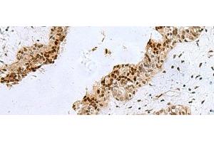 Immunohistochemistry of paraffin-embedded Human breast cancer tissue using H2AFJ Polyclonal Antibody at dilution of 1:170(x200) (H2AFJ 抗体)