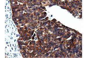 Immunohistochemical staining of paraffin-embedded Adenocarcinoma of Human colon tissue using anti-CBWD1 mouse monoclonal antibody. (CBWD1 抗体)
