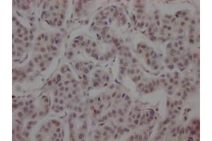 IHC image of ABIN7127371 diluted at 1:100 and staining in paraffin-embedded human breast cancer performed on a Leica BondTM system. (Recombinant BRD4 抗体)
