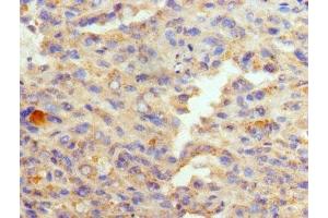Immunohistochemistry of paraffin-embedded human melanoma using ABIN7152009 at dilution of 1:100 (GATA1 抗体  (AA 39-153))
