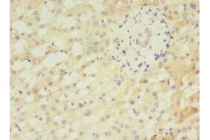 Immunohistochemistry of paraffin-embedded human liver cancer using ABIN7144167 at dilution of 1:100 (ANKMY2 抗体  (AA 1-280))