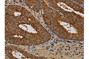 The image on the left is immunohistochemistry of paraffin-embedded Human colon cancer tissue using ABIN7129963(KCNK17 Antibody) at dilution 1/60, on the right is treated with fusion protein. (KCNK17 抗体)
