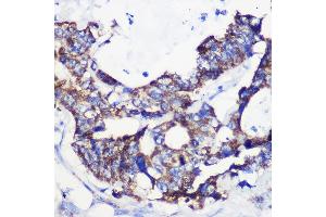 Immunohistochemistry of paraffin-embedded Human colon carcinoma using  Rabbit pAb (ABIN7265426) at dilution of 1:100 (40x lens). (ACSS1 抗体  (AA 340-689))