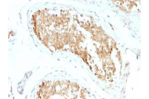 Formalin-fixed, paraffin-embedded human Testicular Carcinoma stained with ALDH1A1 Mouse Monoclonal Antibody (ALDH1A1/1381). (ALDH1A1 抗体  (AA 315-434))