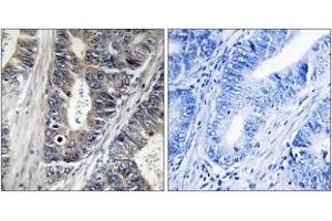 Immunohistochemistry analysis of paraffin-embedded human colon carcinoma tissue, using MAP3K9 Antibody. (MAP3K9 抗体  (AA 561-610))