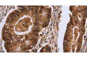 Immunohistochemistry of paraffin-embedded Human colon cancer tissue using EXTL3 Polyclonal Antibody at dilution 1:30 (EXTL3 抗体)