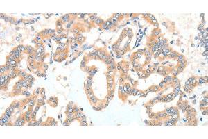 Immunohistochemistry of paraffin-embedded Human thyroid cancer tissue using ADCK1 Polyclonal Antibody at dilution 1:40 (ADCK1 抗体)