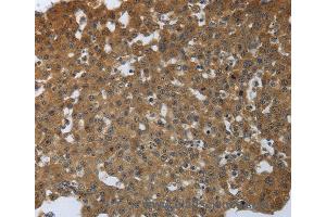 Immunohistochemistry of Human lung cancer using PTPRM Polyclonal Antibody at dilution of 1:40 (PTPRM 抗体)