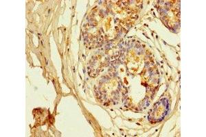 Immunohistochemistry of paraffin-embedded human breast cancer using ABIN7163953 at dilution of 1:100 (Kv1.6/KCNA6 抗体  (AA 1-171))