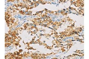 The image on the left is immunohistochemistry of paraffin-embedded Human thyroid cancer tissue using ABIN7129804(IDH3B Antibody) at dilution 1/30, on the right is treated with fusion protein. (IDH3B 抗体)
