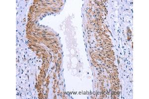 Immunohistochemistry of Human cervical cancer using GPR171 Polyclonal Antibody at dilution of 1:25 (GPR171 抗体)
