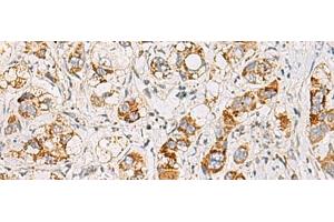 Immunohistochemistry of paraffin-embedded Human liver cancer tissue using MMAB Polyclonal Antibody at dilution of 1:65(x200) (MMAB 抗体)