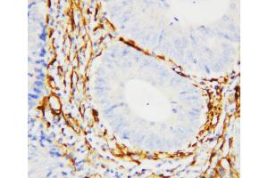 Anti-Galectin 1 antibody, IHC(P) IHC(P): Human Intestinal Cancer Tissue