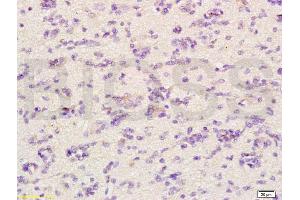 Formalin-fixed and paraffin embedded human glioma labeled with Anti-CHRNA4 Polyclonal Antibody, Unconjugated (ABIN736746) at 1:200 followed by conjugation to the secondary antibody and DAB staining. (CHRNA4 抗体  (AA 531-627))