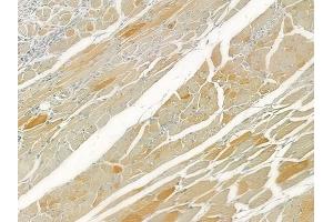 ABIN6260380 and ABIN6276612 at 1/100 staining human tongue carcinoma by IHC-P. (CA3 抗体  (N-Term))