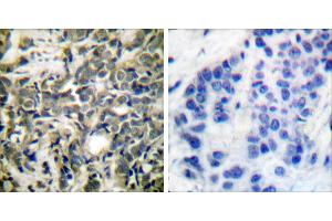 P-peptide - +Immunohistochemical analysis of paraffin-embedded human breast carcinoma tissue using 14-3-3 ζ (phospho-Ser58) antibody. (14-3-3 zeta 抗体  (pSer58))