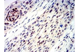 Immunohistochemical analysis of paraffin-embedded esophageal cancer tissues using TFAP2C mouse mAb with DAB staining. (TFAP2C 抗体  (AA 341-450))