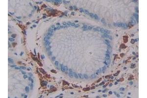 Detection of LAT2 in Human Stomach cancer Tissue using Polyclonal Antibody to Linker For Activation Of T-Cells Family, Member 2 (LAT2) (LAT2 抗体  (AA 30-209))