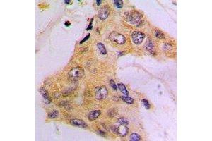 Immunohistochemical analysis of Beta-tubulin-HRP labled staining in human breast cancer formalin fixed paraffin embedded tissue section.