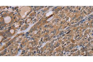 Immunohistochemistry of paraffin-embedded Human thyroid cancer tissue using NAA25 Polyclonal Antibody at dilution 1:40 (NAA25 抗体)
