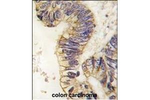 Formalin-fixed and paraffin-embedded human colon carcinoma tissue reacted with SRC1 antibody (C-term) (ABIN391825 and ABIN2841670) , which was peroxidase-conjugated to the secondary antibody, followed by DAB staining. (NCOA1 抗体  (C-Term))