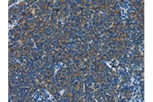 The image on the left is immunohistochemistry of paraffin-embedded Human Lymphoma tissue using ABIN7190319(CNTNAP3 Antibody) at dilution 1/40, on the right is treated with synthetic peptide. (CNTNAP3 抗体)