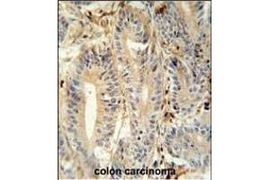 MEP1A antibody (N-term) (ABIN652039 and ABIN2840513) immunohistochemistry analysis in formalin fixed and paraffin embedded human colon carcinoma followed by peroxidase conjugation of the secondary antibody and DAB staining. (MEP1A 抗体  (N-Term))