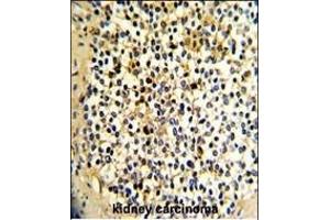 Formalin-fixed and paraffin-embedded human kidney carcinoma with DCXR Antibody (Center), which was peroxidase-conjugated to the secondary antibody, followed by DAB staining. (DCXR 抗体  (AA 79-106))