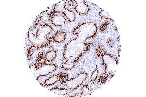 Prostatic adenocarcinoma Gleason 336 with strong granular perinuclear cytoplasmic prostein staining of tumor cells (Recombinant SLC45A3 抗体  (N-Term))