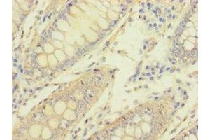 Immunohistochemistry of paraffin-embedded human colon cancer using ABIN7162103 at dilution of 1:100 (MACROD1 抗体  (AA 83-325))