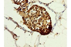 IHC image of ABIN7154867 diluted at 1:200 and staining in paraffin-embedded human breast cancer performed on a Leica BondTM system. (HSP70 1A 抗体  (AA 418-512))