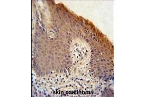 KRT1 Antibody (Center) (ABIN651241 and ABIN2840150) immunohistochemistry analysis in formalin fixed and paraffin embedded human skin carcinoma followed by peroxidase conjugation of the secondary antibody and DAB staining. (KRTAP1-1 抗体  (AA 88-117))