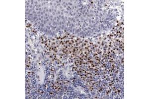Immunohistochemical staining of human IRF4 polyclonal antibody  shows strong nuclear positivity in lymphoid cells outside reaction centra at 1:250 dilution.